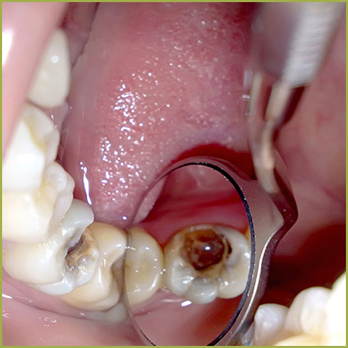 gangrena zuba